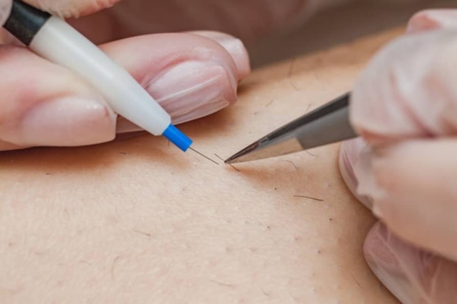 Electrolysis Hair Removal (Male)